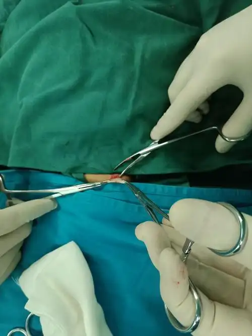 太和县人民医院五星病区疝气专科疝气手术过程鉴赏