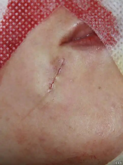 我做的一个色素痣切除缝合即刻