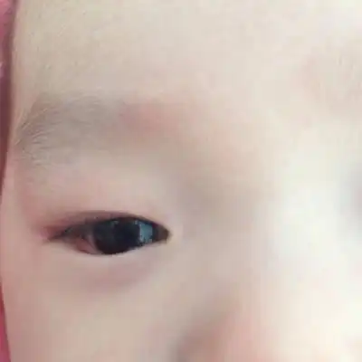 婴儿5个月了右眼睛总是流泪,眼睫毛有几根渣眼睛,左眼就没有事,请问是