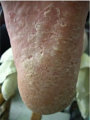 水泡型脚气什么症状图片