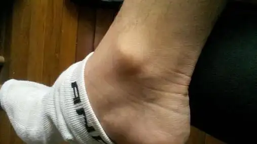 脚踝扭伤后骨质增生怎么办中医治疗脚踝扭伤后骨质增生