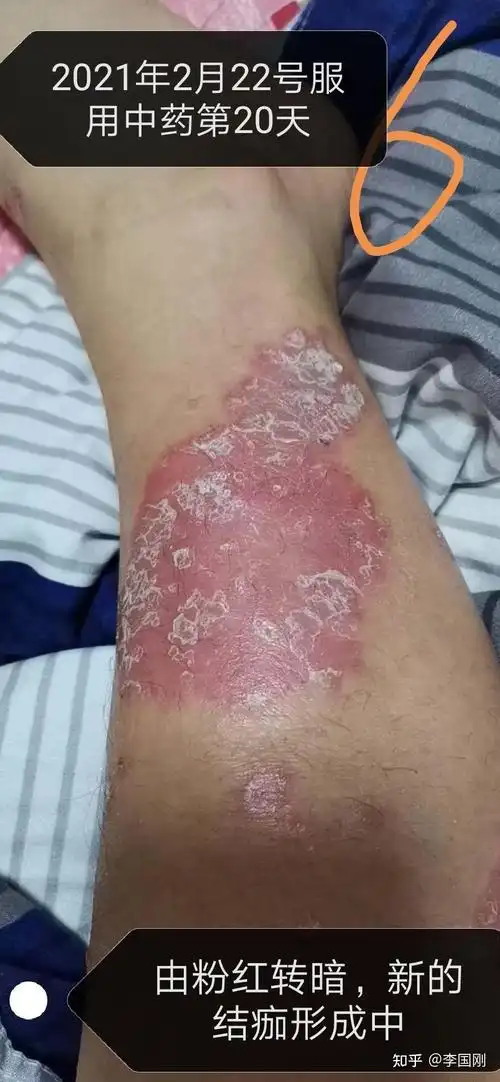 寻常型银屑病腿部块状消退过程图片(上) - 知乎