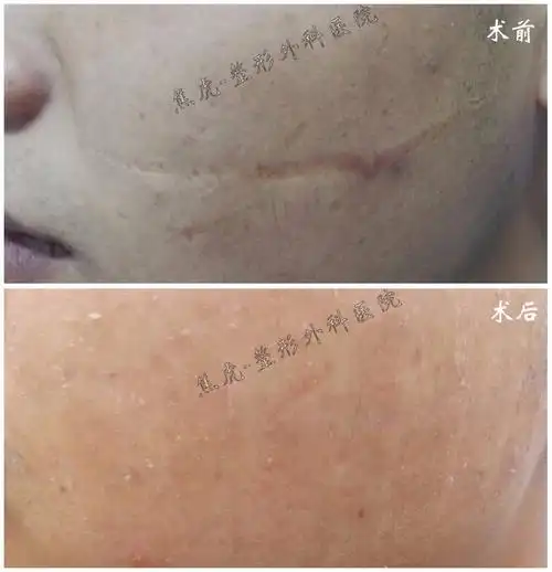 面诊本人后,给予切除原有疤痕,重新进行减张美容缝合,术后贴免缝胶布
