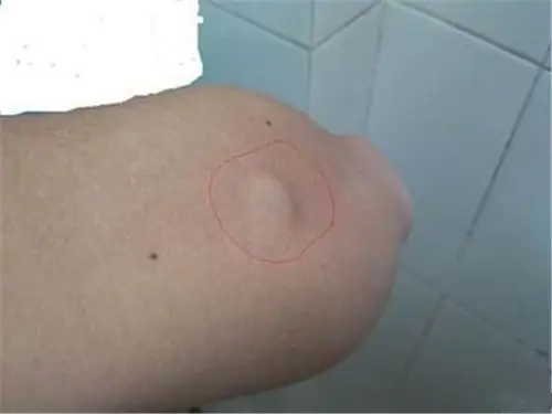 手臂皮下脂肪瘤图片