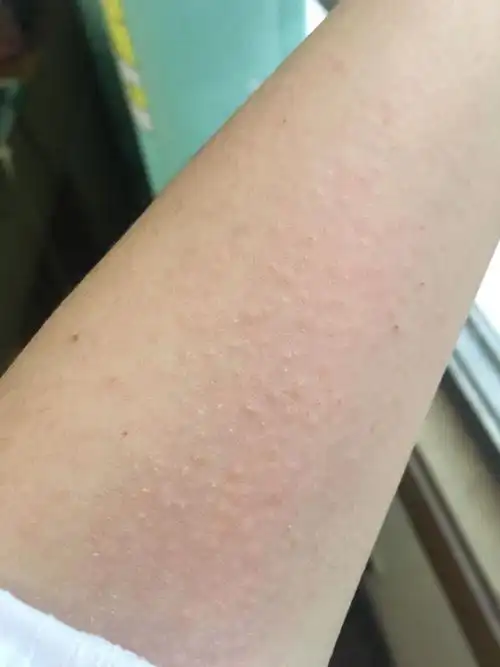 最近胳膊特别痒 然后长出颗粒状的小疙瘩 非常小 很痒 一抓就红就有小