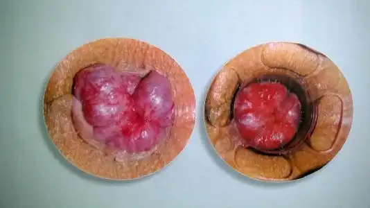 痔核脱出必须手术吗 外痔核脱出要怎么办