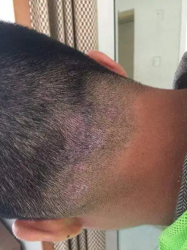 头皮癣图片 (52)