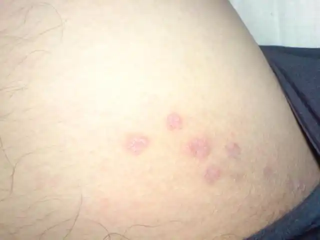 腹股沟起小红疙瘩怎么办