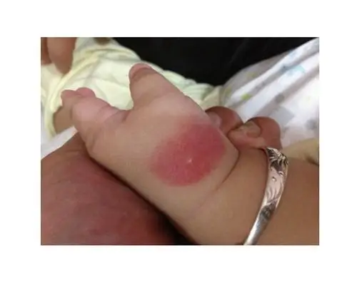 虫咬性皮炎图片 (109)_有来医生