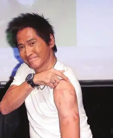 齐秦展示烧伤调侃自己:嘴巴一度肿得像猪一样