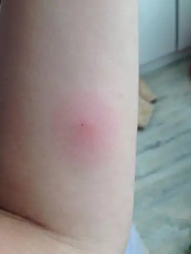 [试管婴儿]ppd检查阳性怎么办?17乘18,表面没有水泡