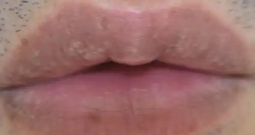 还是对镜子的时候无意间发现的,去医院看了下,医生说是皮脂腺异位症