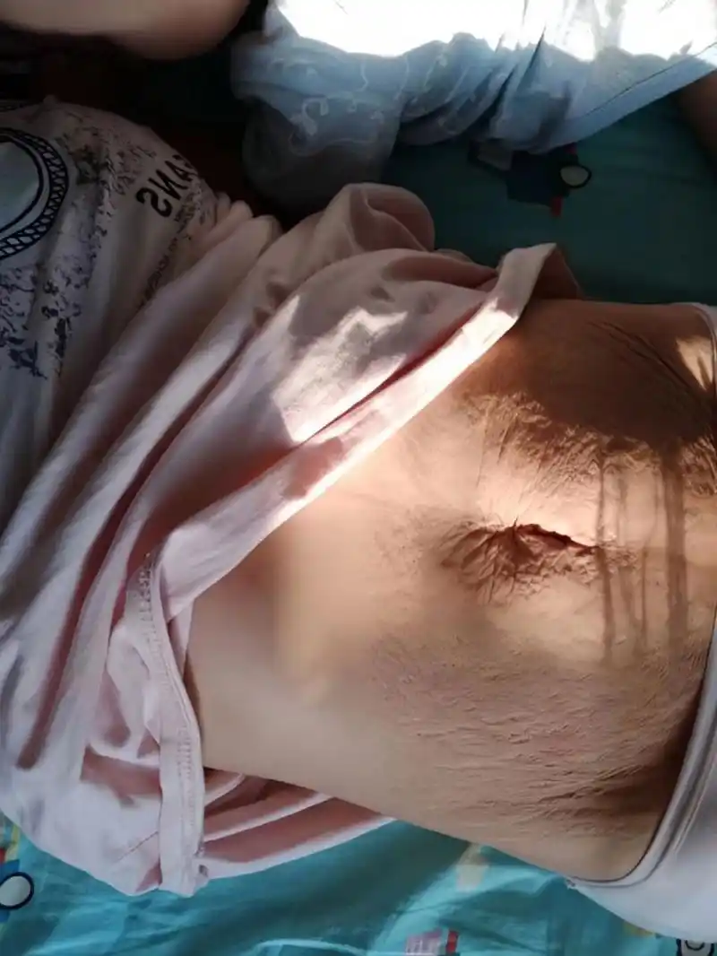 产后妊娠纹 肚皮松弛真的很恐怖 好后悔.怀孕的时候没好好打理妊娠纹.