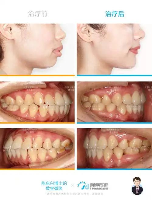 龅牙露龈笑牙齿矫正案例