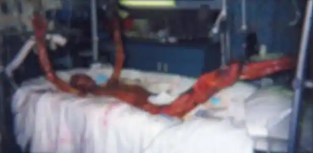 遭遇核辐射的人死亡前有多痛苦?上世纪末的这位日本人敲响警钟!