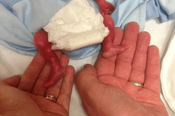 下这张照片告别胎死腹中的宝宝  妈妈特西和丈夫菲尔一直尝试怀孕5年