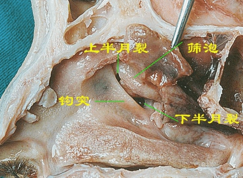 是鼻腔外侧壁结构中最为重要和复杂的部位,也是在鼻内镜手术最常用的