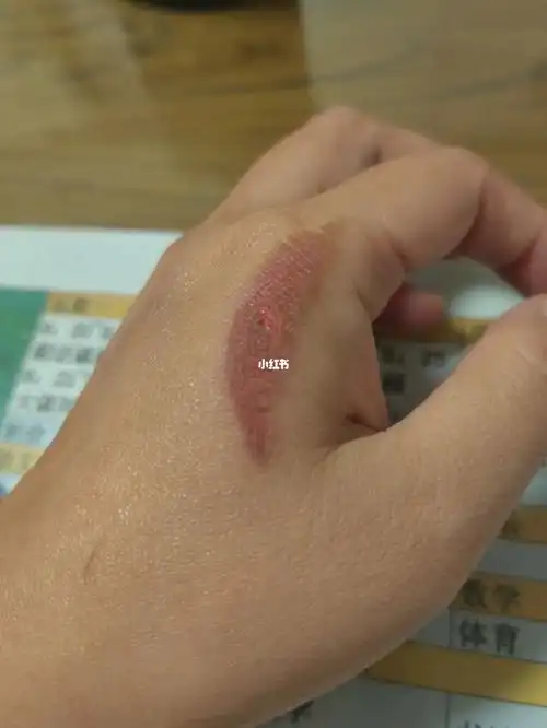 受伤的手来问问说冷制皂碱性伤害皮肤的