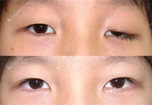 曹仁昌院长单侧重度上睑下垂矫正对比