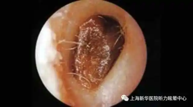 但 由于掏耳不当等原因,耳垢堆积较多且被推入耳道深部后,可能会 堵塞