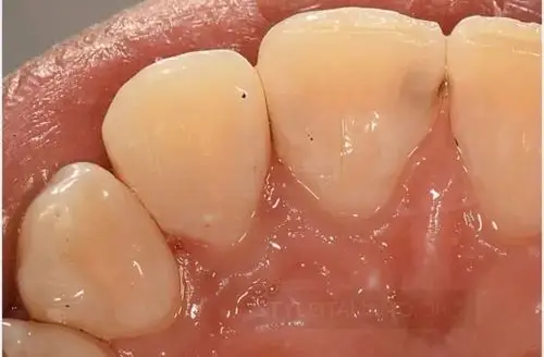 病例分享前牙邻面龋的治疗技巧