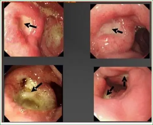 慢性十二指肠溃疡症状图片