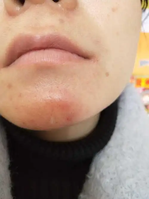 一开始下巴长了个痘我挤出了白色的东西,然后没管它