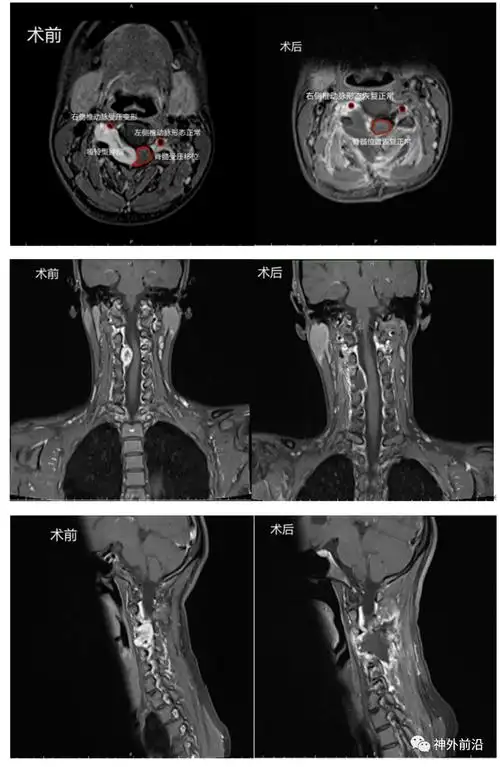 内镜前沿内镜手术切除高位颈髓哑铃型肿瘤同时减少骨质破坏一例世纪坛