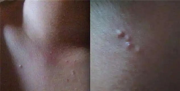 脖子上的"小肉粒",可不要忽视大意,也许是身体发出的信号