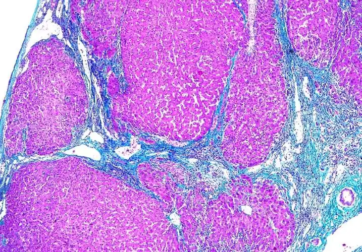 masson染色-肝脏肝硬化