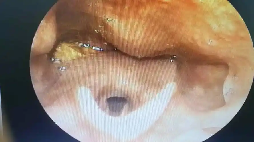 医院新闻5厘米的蟹脚卡吓坏晋南老人晋南医生巧手助脱险