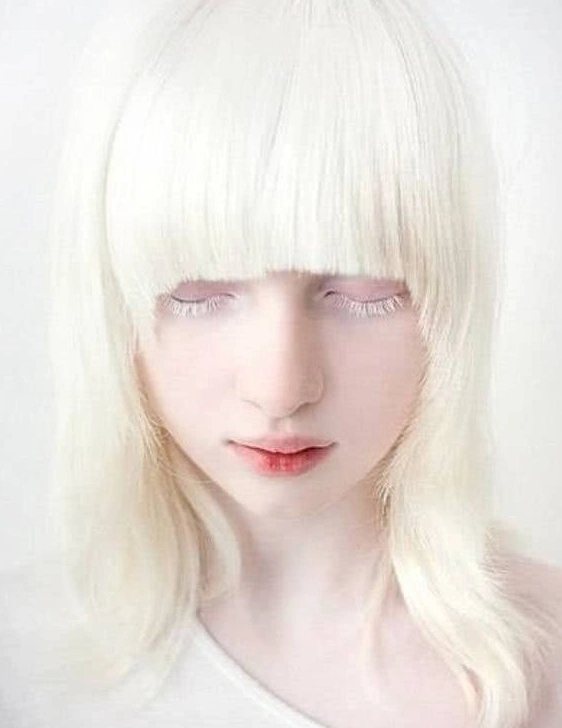 乌克兰女孩患罕见白化病全身雪白,从小遭人嘲笑,如今成模特!