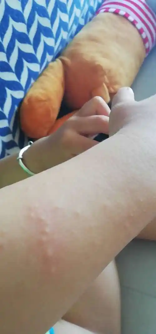 您好2岁儿童昨晚发现胳膊上出了一些米粒大小的疙瘩