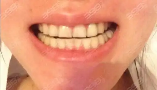 门牙磨短的对比照片来了 看门牙太长到底可以磨小吗?