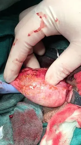 手术中从睾丸鞘膜吸出大量淡黄色清亮液体,鞘膜增厚,行鞘膜切除后发现