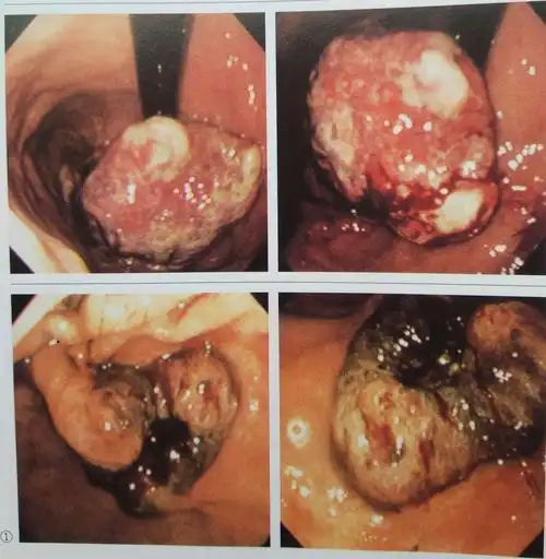 热烈祝贺宁都翠微医院无痛胃镜投入使用