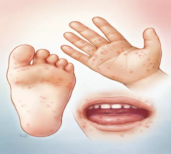 一期图谱,让您彻底读懂柯萨奇a组6型手足口病_手足口病_手足口病症状