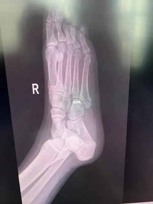 第五跖骨骨折