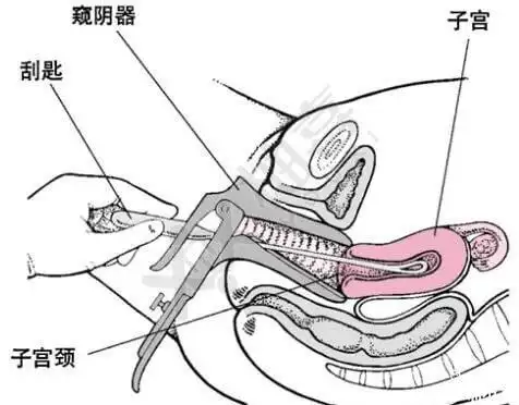 刮宫术(示意图)对csp行吸宫,刮宫手术常常导致严重的难以控制的子宫