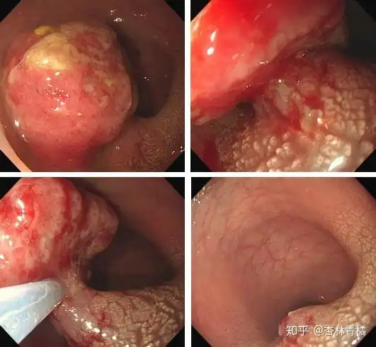3岁宝宝肛门脱出一块肉团
