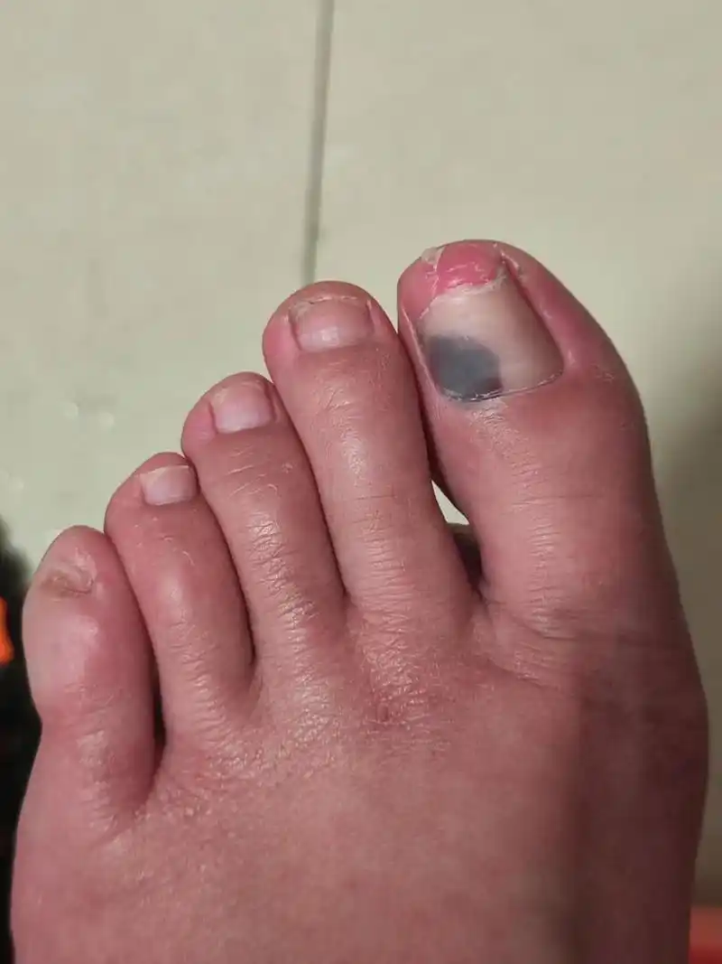 有姐们知道我脚指甲怎么回事吗 不知道我这个大脚指的脚上怎么黑了一