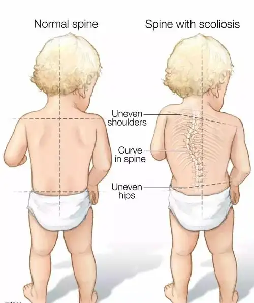 但有一种特发性脊柱侧弯,早期不易发觉.