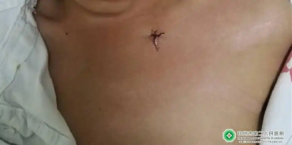 8龄童摔跤致剪刀刺入胸壁 胸外科专家精湛手术转危为安