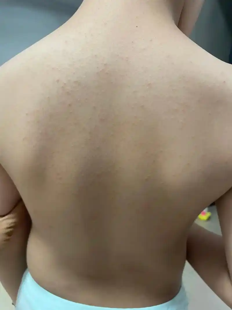 孩子后背出的痱子精油