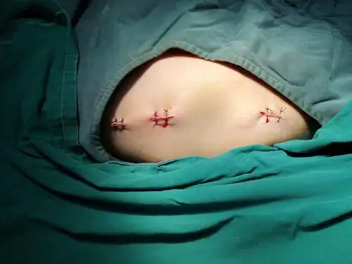 粗隆部骨折的手术治疗