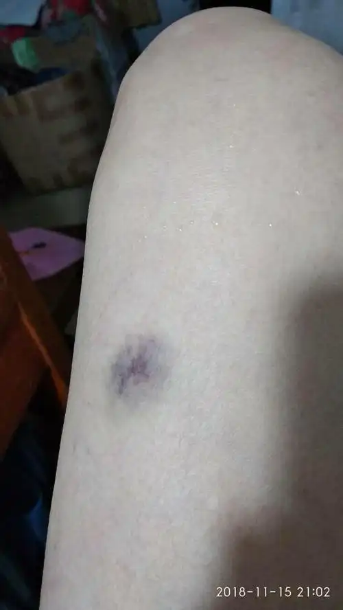 大腿被撞了一下变成紫黑色是什么原因