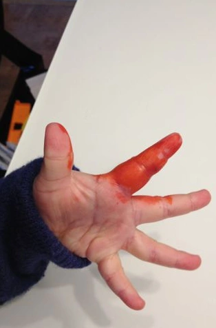 手出血的图片61