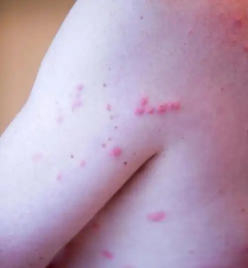 看图对比,就能知道自己是被啥咬了