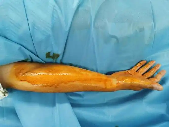 冠状动脉造影球囊扩张术支架植入术