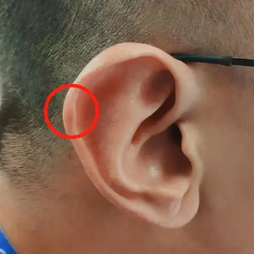 (图片来源:同事的耳朵)这块小突起主要是由软骨和覆盖在其上的一层